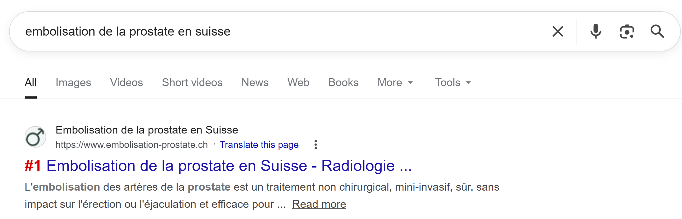 Embolisation Prostate